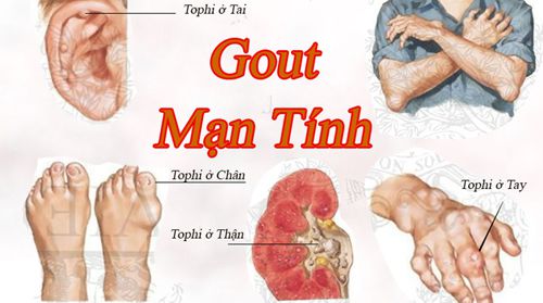 bệnh đau nhức xương khớp ở người già