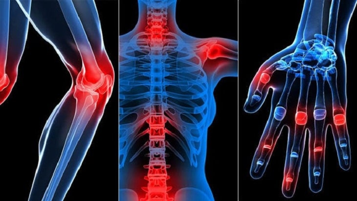 dau nhuc xuong khop thuong gap o co lung va cac khop Đau nhức xương khớp thường gặp ở cổ lưng và các khớp