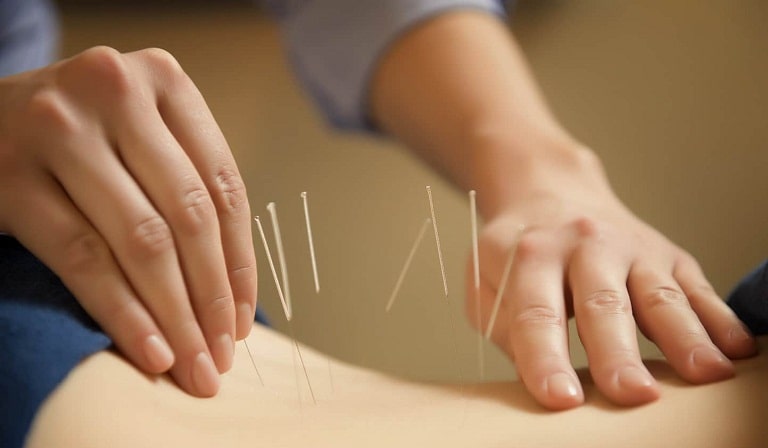 châm cứu chữa thoái hóa đốt sống lưng châm cứu chữa thoái hóa đốt sống lưng