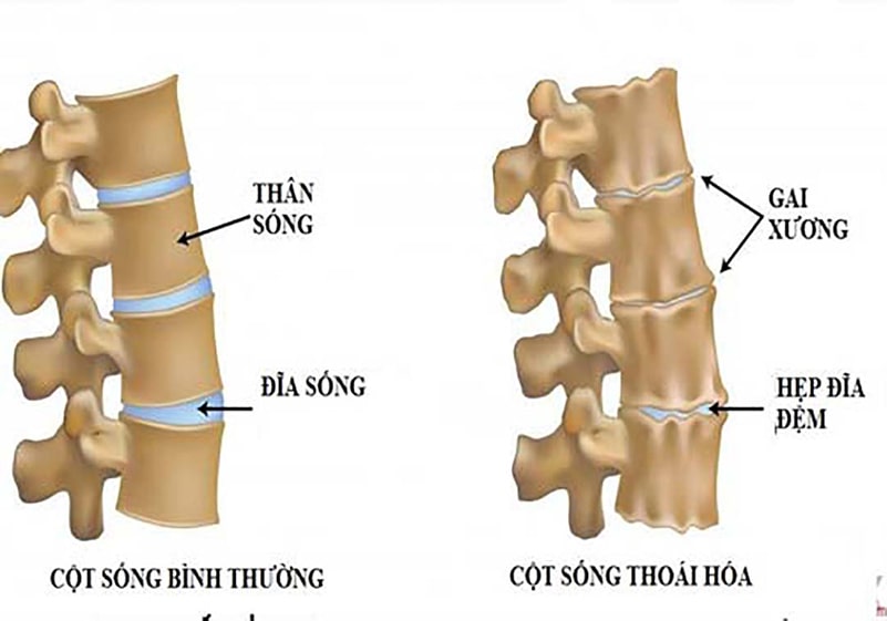 thoai hoa dot song gay nen nhieu benh ly nguy hiem Thoái hóa đốt sống gây nên nhiều bệnh lý nguy hiểm
