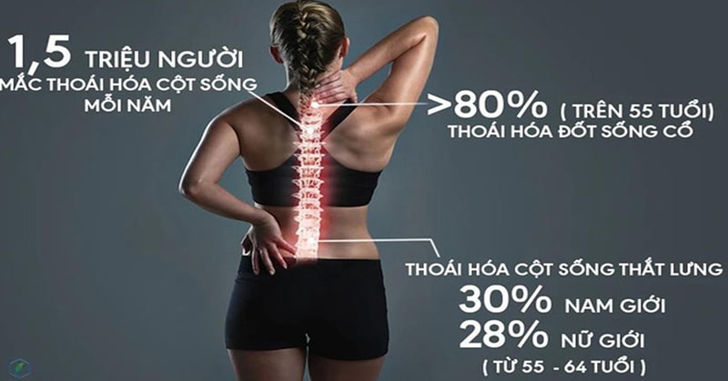 thoai hoa dot song ngay cang bi tre hoa Thoái hóa đốt sống ngày càng bị trẻ hóa
