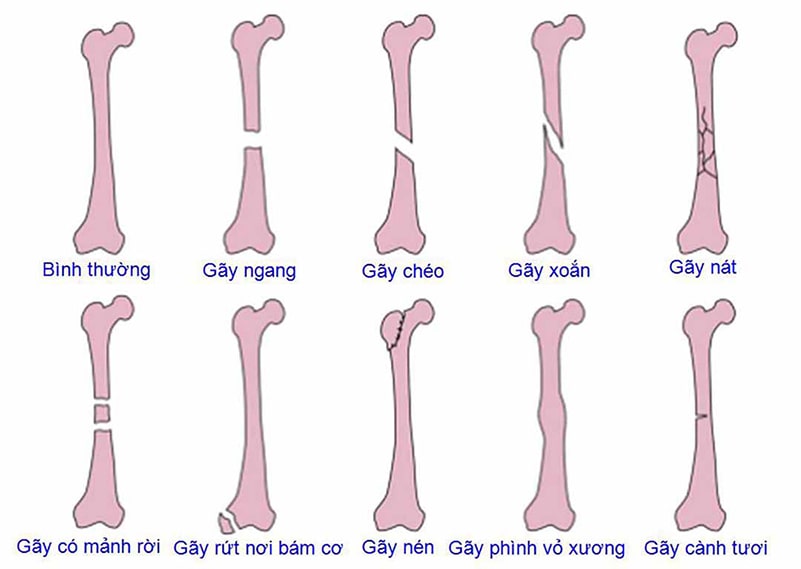 hinh anh mo phong cac loai gay xuong Hình ảnh mô phỏng các loại gãy xương