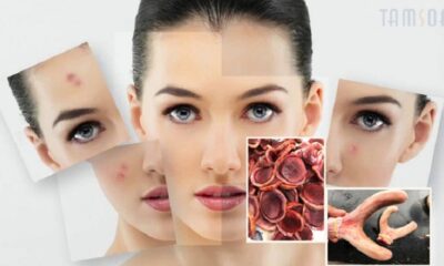 Nhung hươu trị mụn hiệu quả