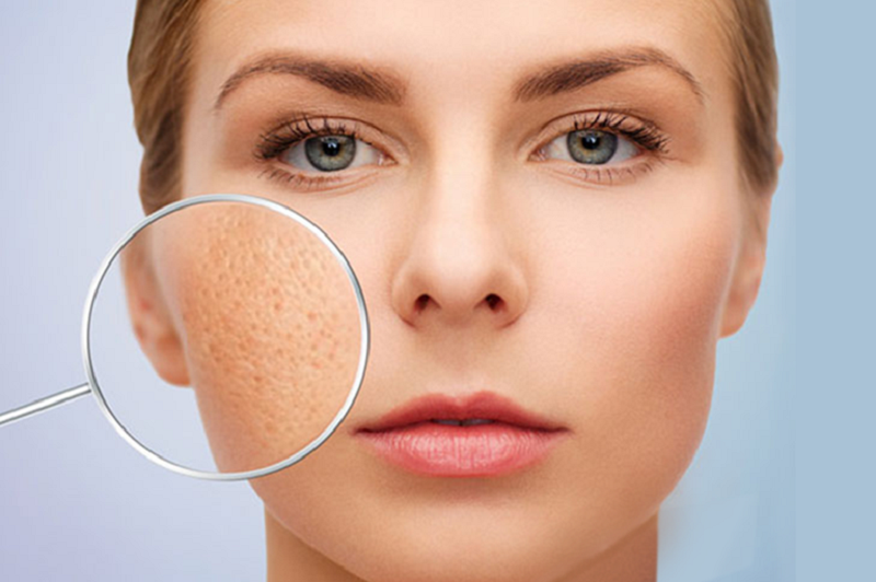 Da xuất hiện những nếp nhăn và lỗ chân lông to dần