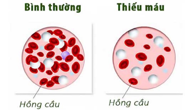 Bệnh thiếu máu khiến người bệnh hoa mắt chóng mặt chân tay bủn rủn