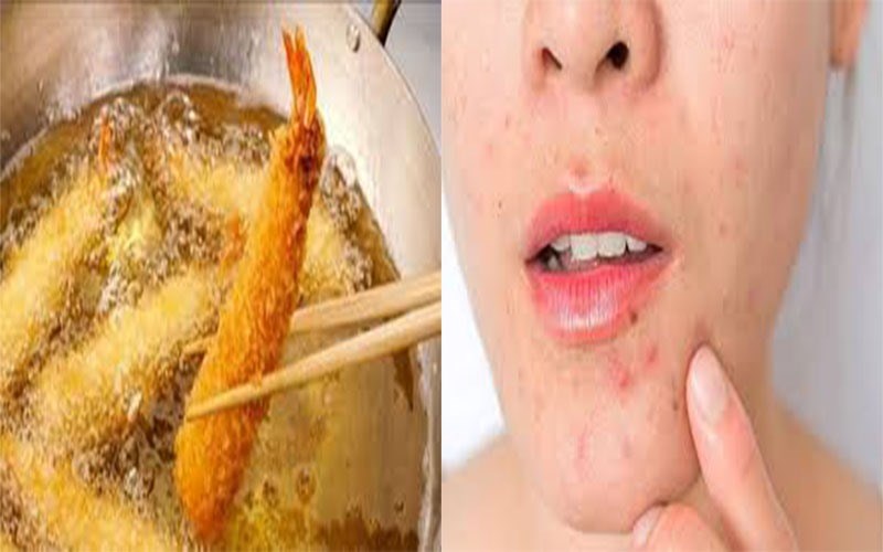 Sử dụng nhiều đồ ăn dầu mỡ sẽ không tốt cho làn da