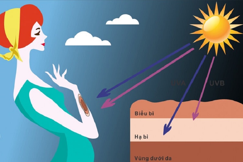 Tia UV từ mặt trời khiến collagen và mô liên kết dưới da bị hủy hoại.