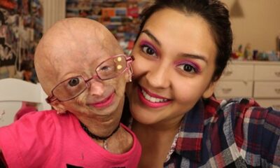 Hình ảnh cô bé Adalia Rose (bên trái) mắc căn bệnh Progeria – Bệnh lão hóa sớm
