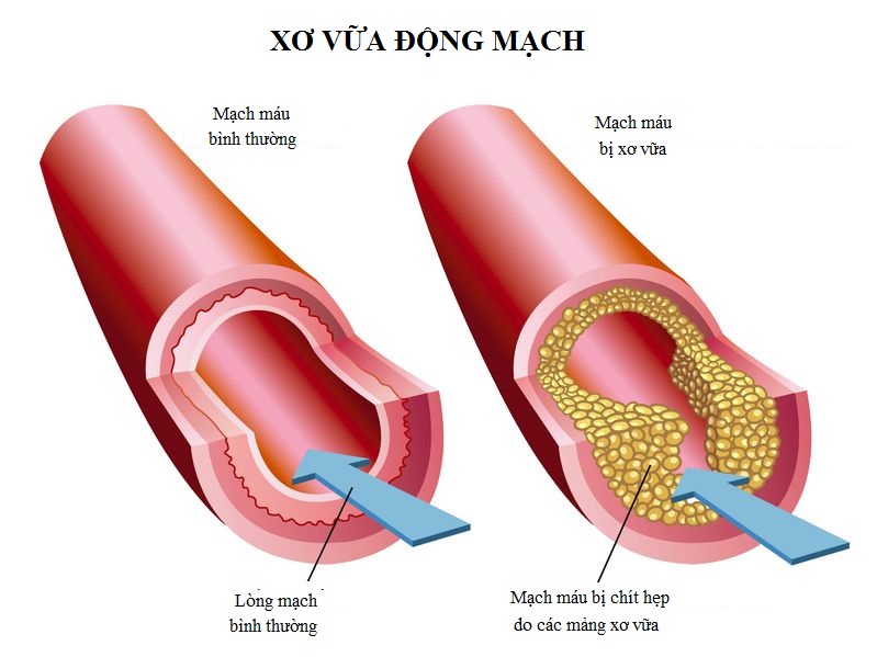 Các mảng xơ vữa động mạch có thể làm thu hẹp lòng mạch, gây thiếu máu lên não