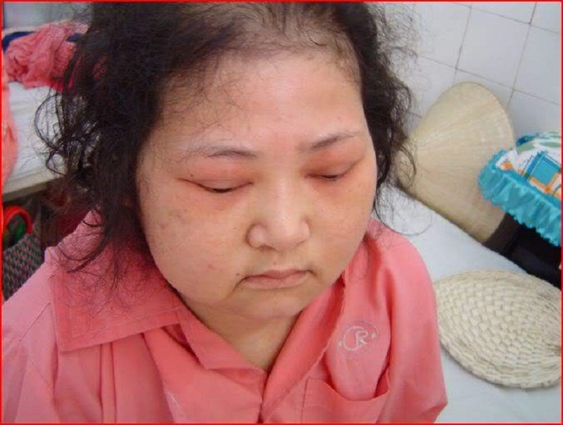 Bệnh nhân bị hội chứng Cushing, giữ nước khi sử dụng Hydrocortison