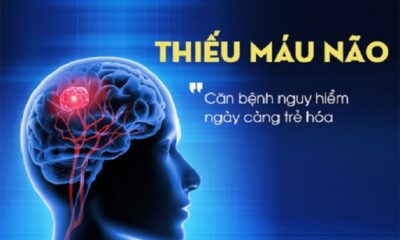 Thiếu máu não là hiện tượng giảm tuần hoàn máu lên não