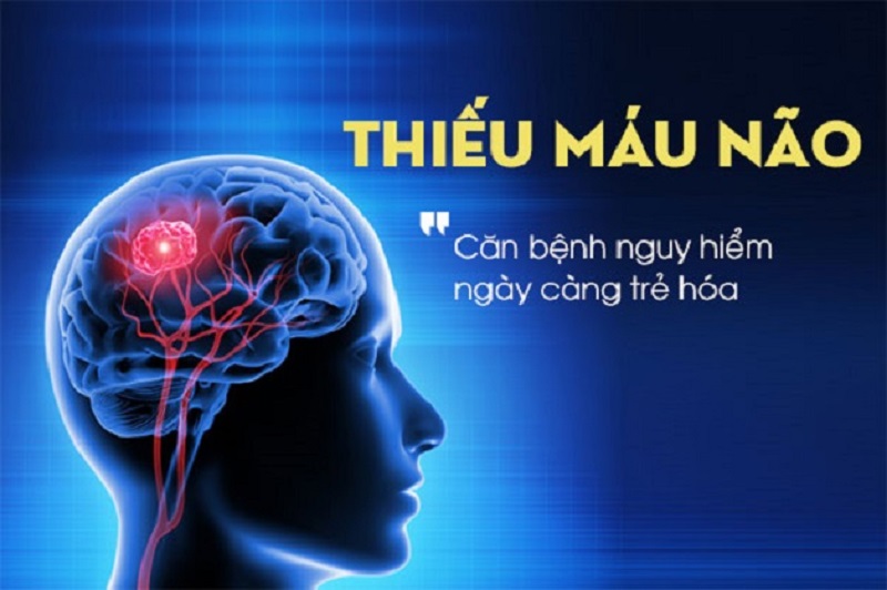 Thiếu máu não là hiện tượng giảm tuần hoàn máu lên não