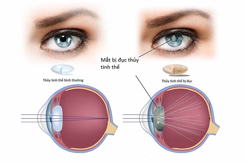Hoa mắt mờ mắt do mắt bị đục thủy tinh thể