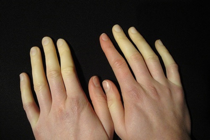 Hội chứng Raynaud khiến máu không được lưu thông gây ra hiện tượng tê cứng tay