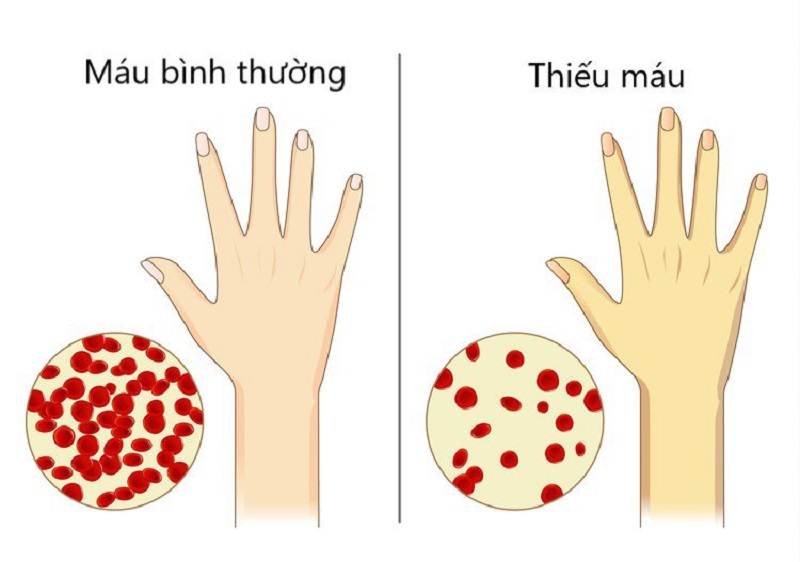 Nhận biết các biểu hiện thiếu máu là kiến thức cần phải biết dành cho người thiếu máu