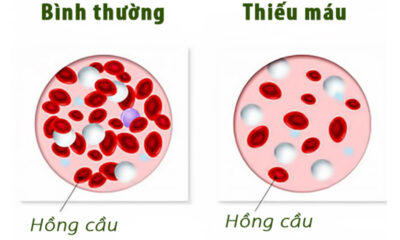 Bệnh thiếu máu là gì