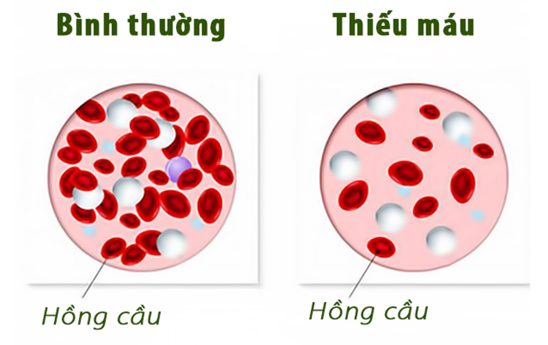 Bệnh thiếu máu là gì