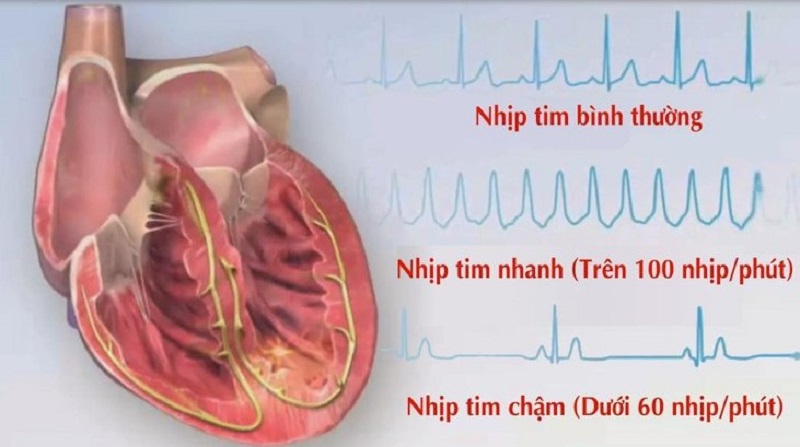Rối loạn nhịp tim được coi là nguyên nhân khiến bạn hay bị hoa mẳt