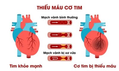 Nhịp tim không đều cũng có thể là triệu chứng của thiếu máu