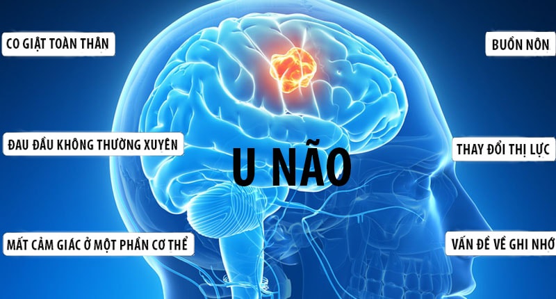 Dấu hiệu ban đầu của bệnh u não là hoa mắt