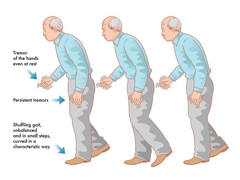 Bệnh Parikison cũng dẫn đến những triệu chứng hoa mắt, mất thăng bằng, đầu óc choáng váng