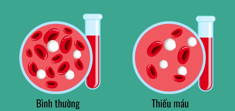 Thiếu máu