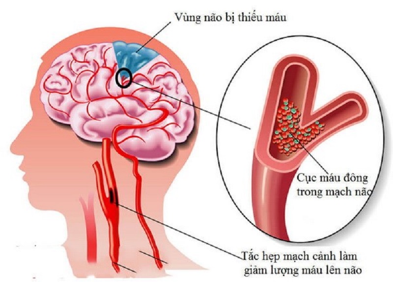 Thiếu máu não nguyên nhân chính gây hoa mắt
