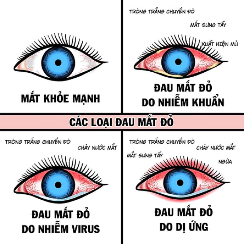 Nguyên nhân gây đau mắt đỏ