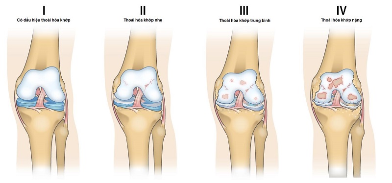 Thoái hóa khớp gối được chia thành 4 giai đoạn theo mức độ nặng dần