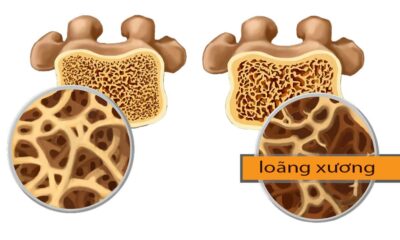 Biện pháp hiệu quả để phòng ngừa loãng xương ở người già