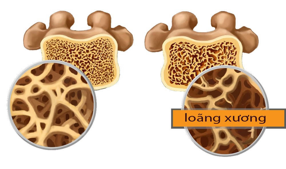 Biện pháp hiệu quả để phòng ngừa loãng xương ở người già